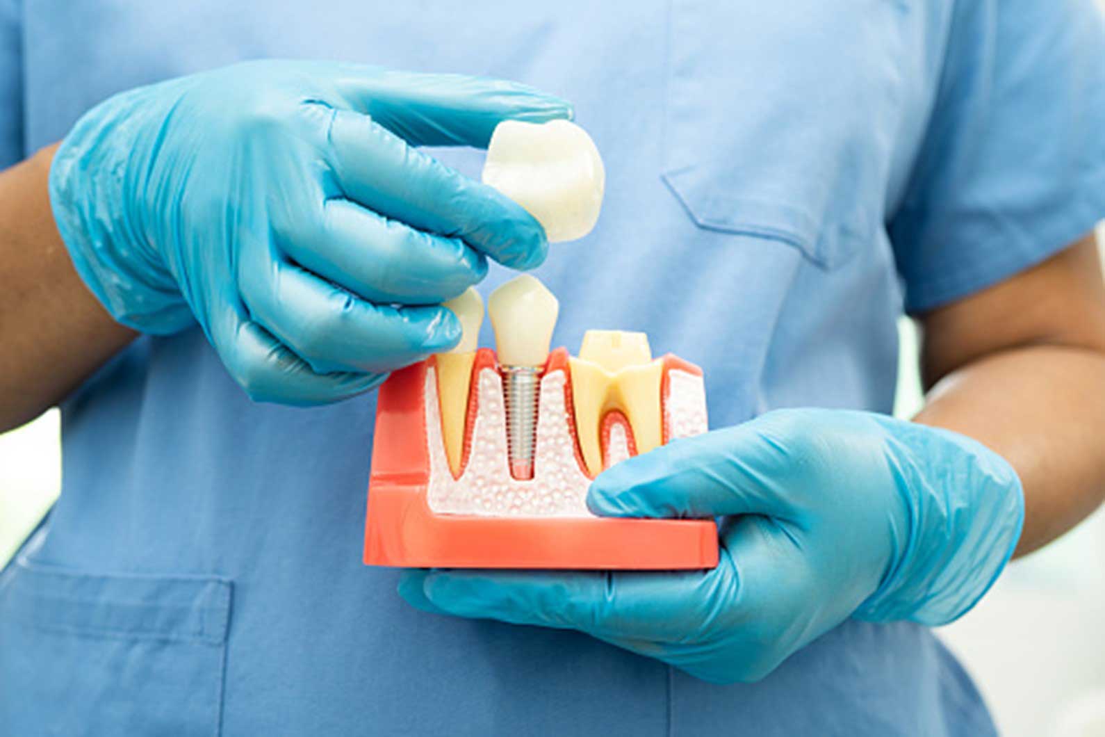 Close-up of dental implant model showing tooth structure at South Ogden & Kaysville, UT clinic