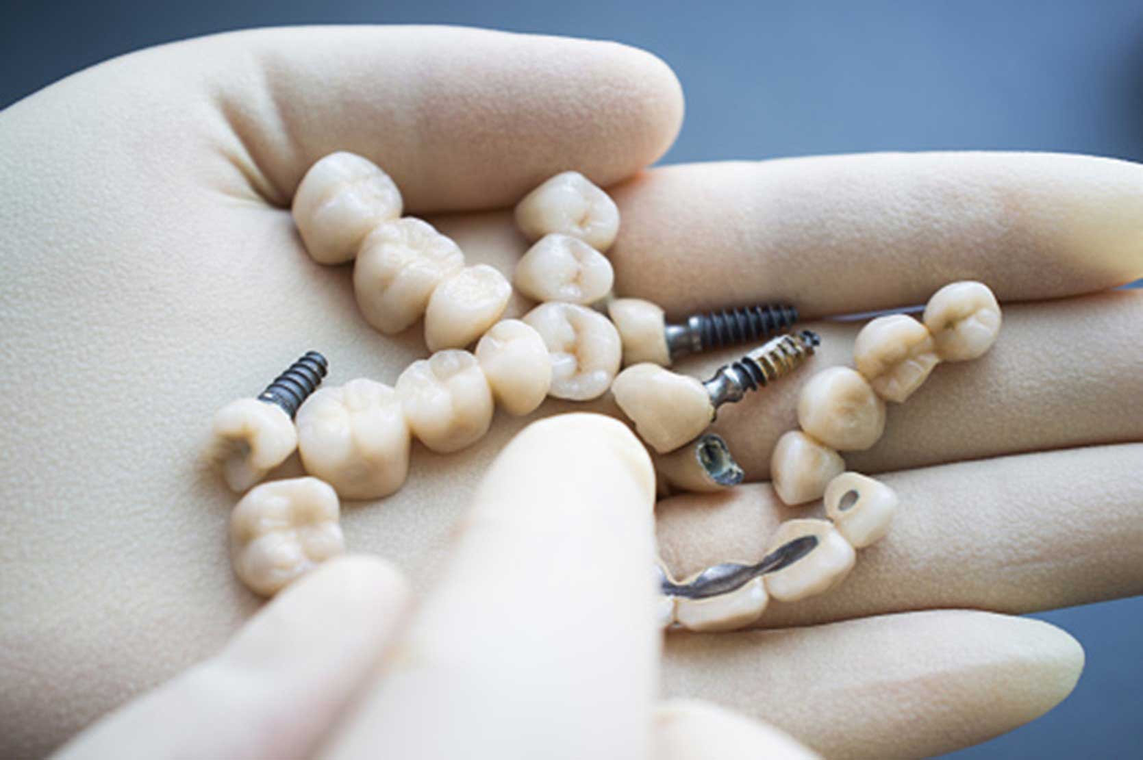 Implant dentist holding artificial teeth with titanium screws in South Ogden & Kaysville, UT