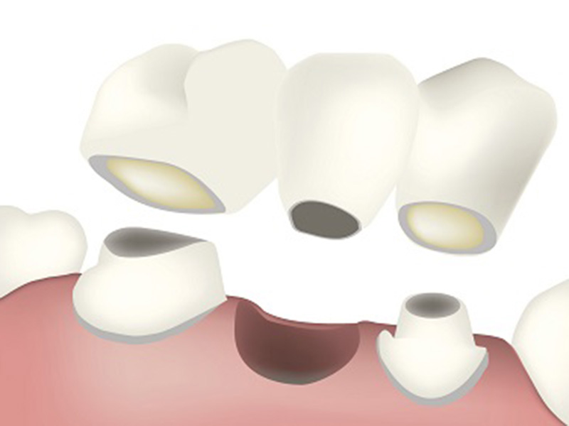 Featured image for “Dental Implants as a Replacement Option for Aging Bridges”