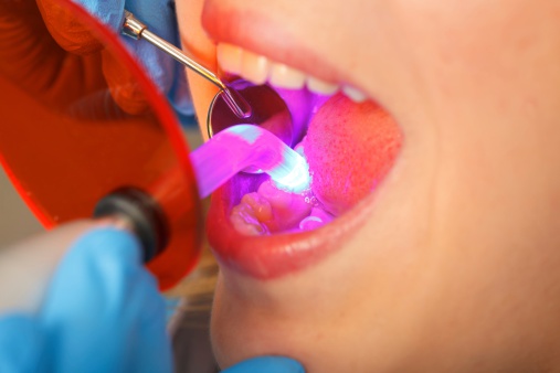 Dental obturation