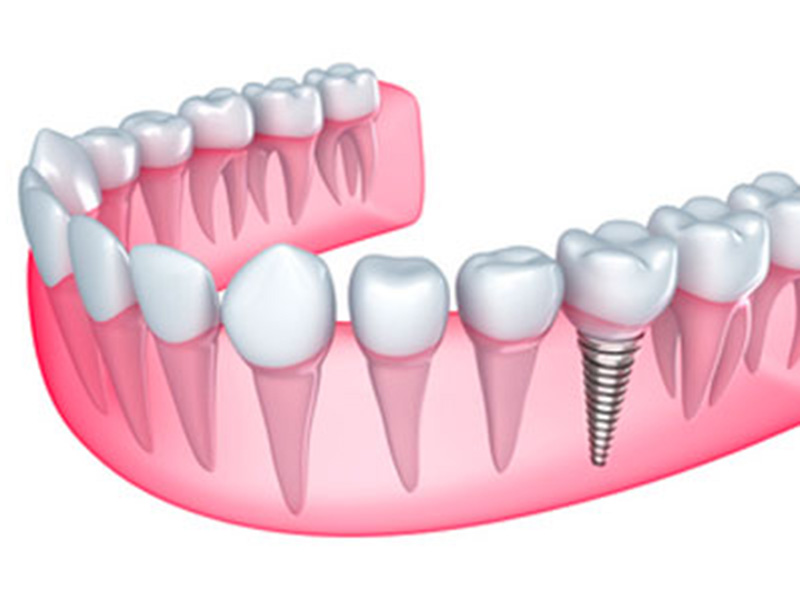 Featured image for “Most Common Reasons Dental Implants Fail”