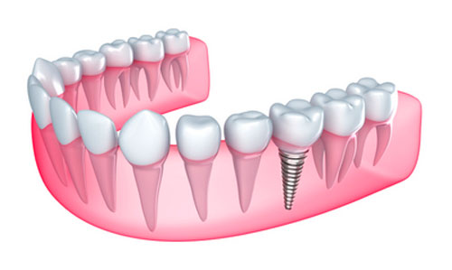 dental implants