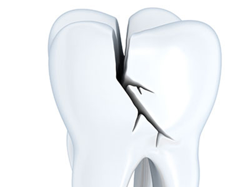 Featured image for “Kid’s Damaged Teeth May Need a Different Approach Than Adults’”