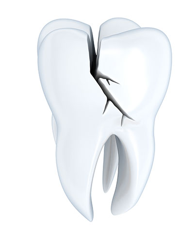 cracked tooth