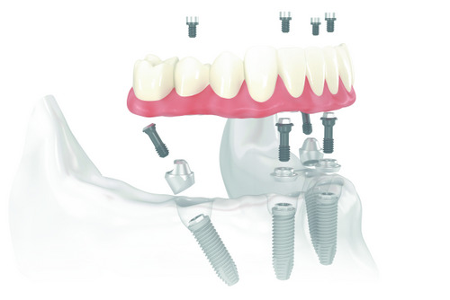 dental implant