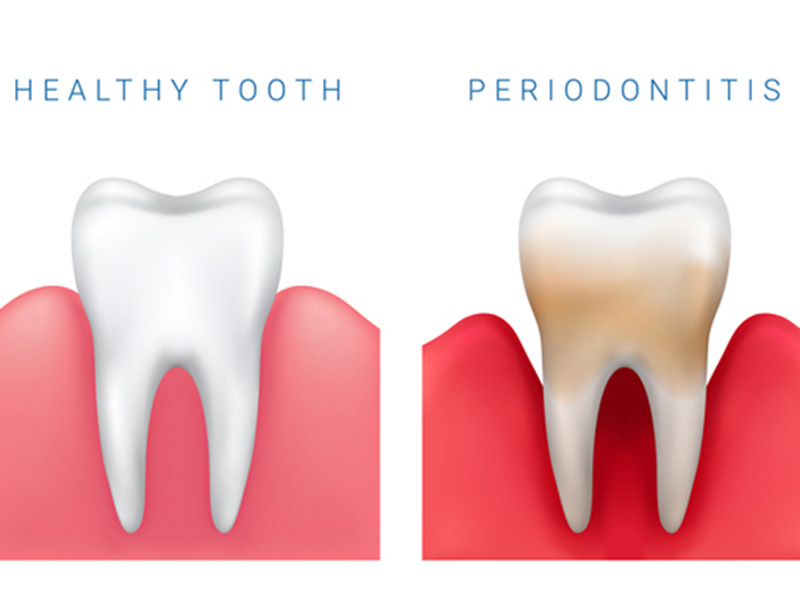 Featured image for “Uses of Antibiotics in Periodontics”