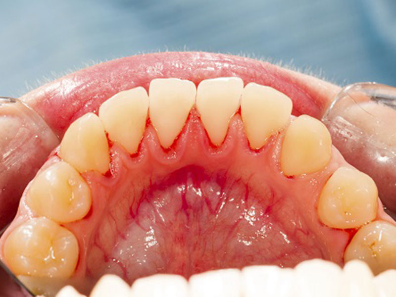 Featured image for “Home Care For Periodontal Disease”