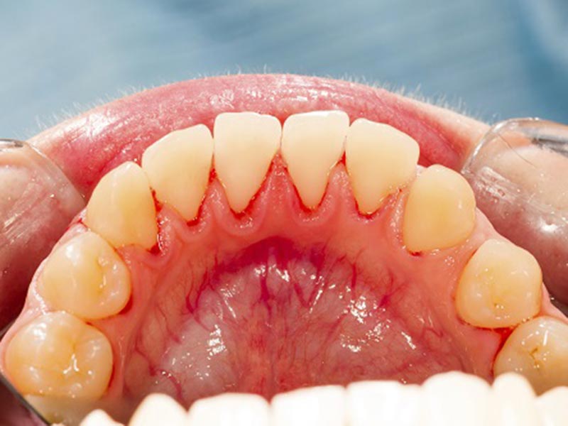 Featured image for “What Untreated Gum Disease Does to the Body”