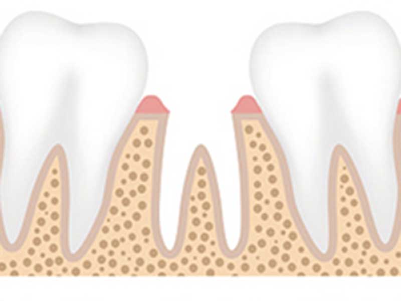 Featured image for “Tooth Loss”